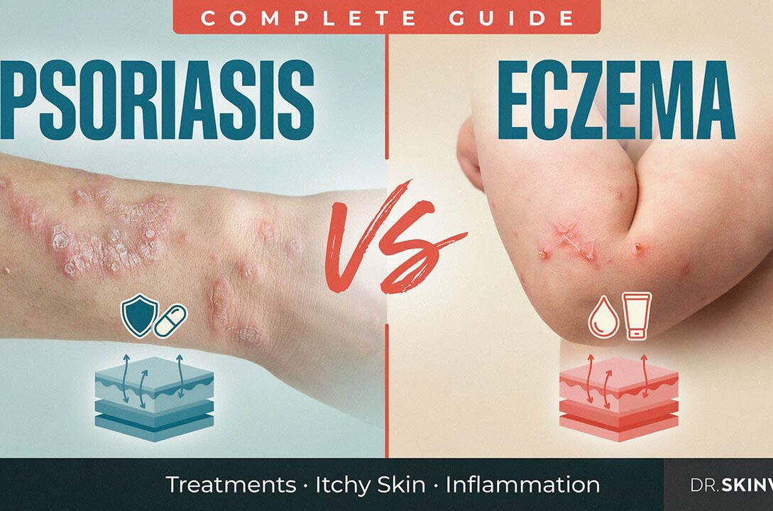 Psoriasis vs Eczema Complete Guide: Treatments, Itchy & Inflamed Skin