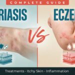 Psoriasis vs Eczema Complete Guide: Treatments, Itchy & Inflamed Skin
